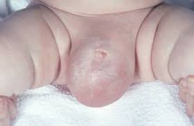 Hidrosel I Spermatosel