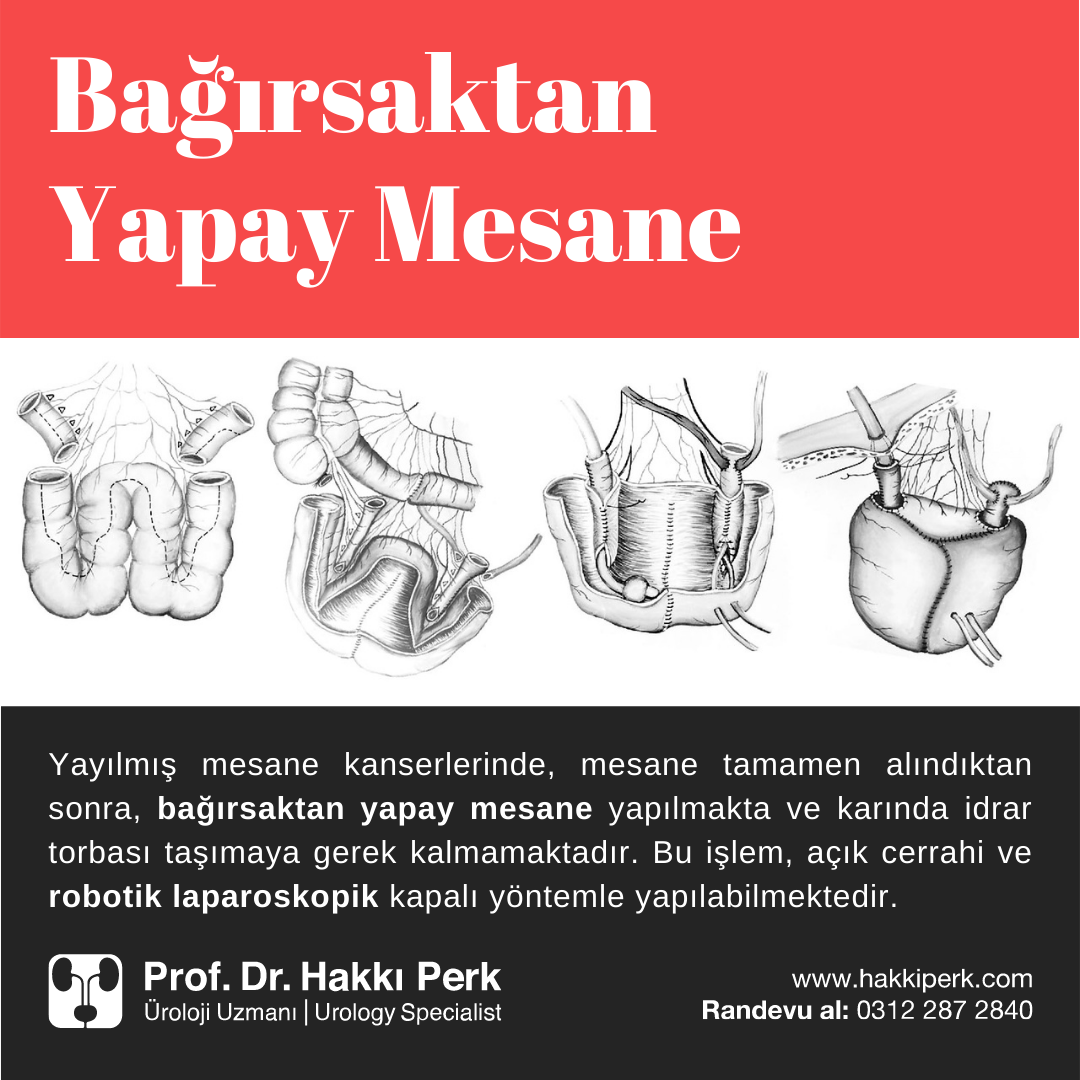 Yayılmis-Mesane-Kanseri-Yapay-Mesane