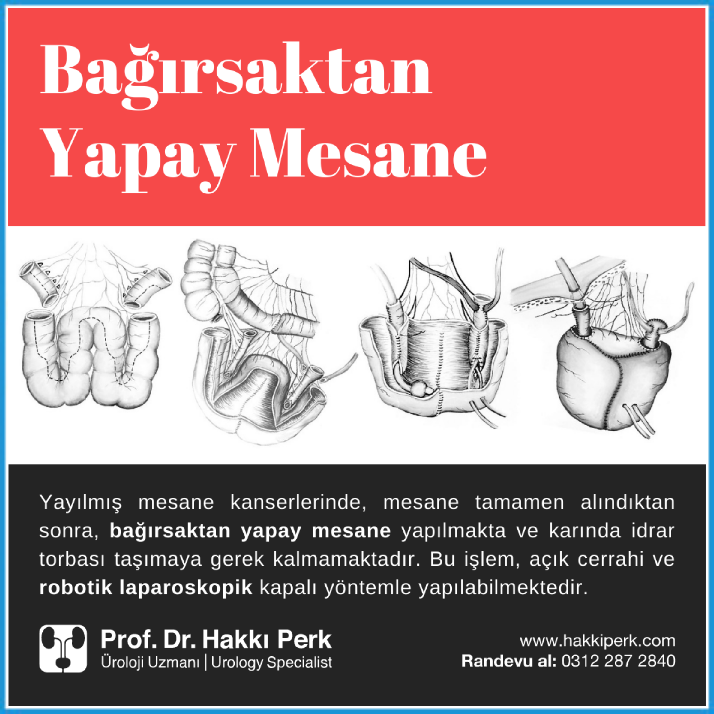 Radikal Sistektomi ve Yapay Mesane