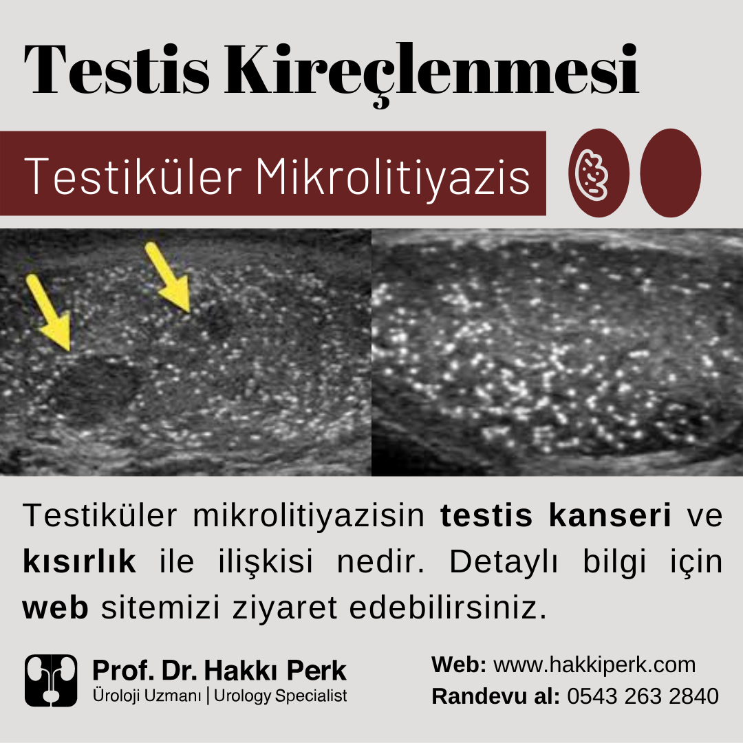 Testiküler Mikrolitiyazis