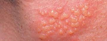 Genital Herpes Enfeksiyonu, Genital Uçuk, HSV